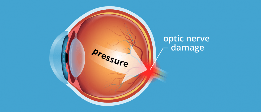 glaucoma