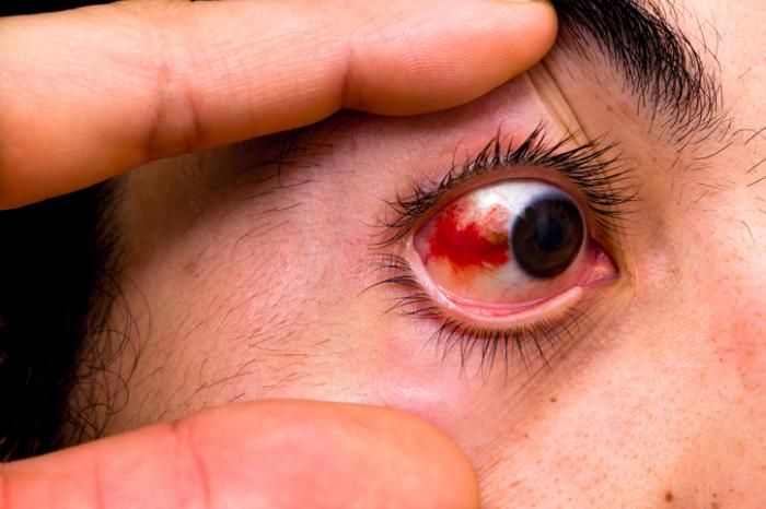 Can Bloodshot Eyes Be Serious? 10 Symptoms to Be Aware of - GoodRx