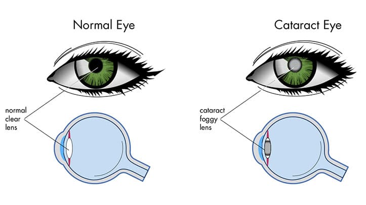 cataract meaning