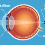 presbyopia meaning