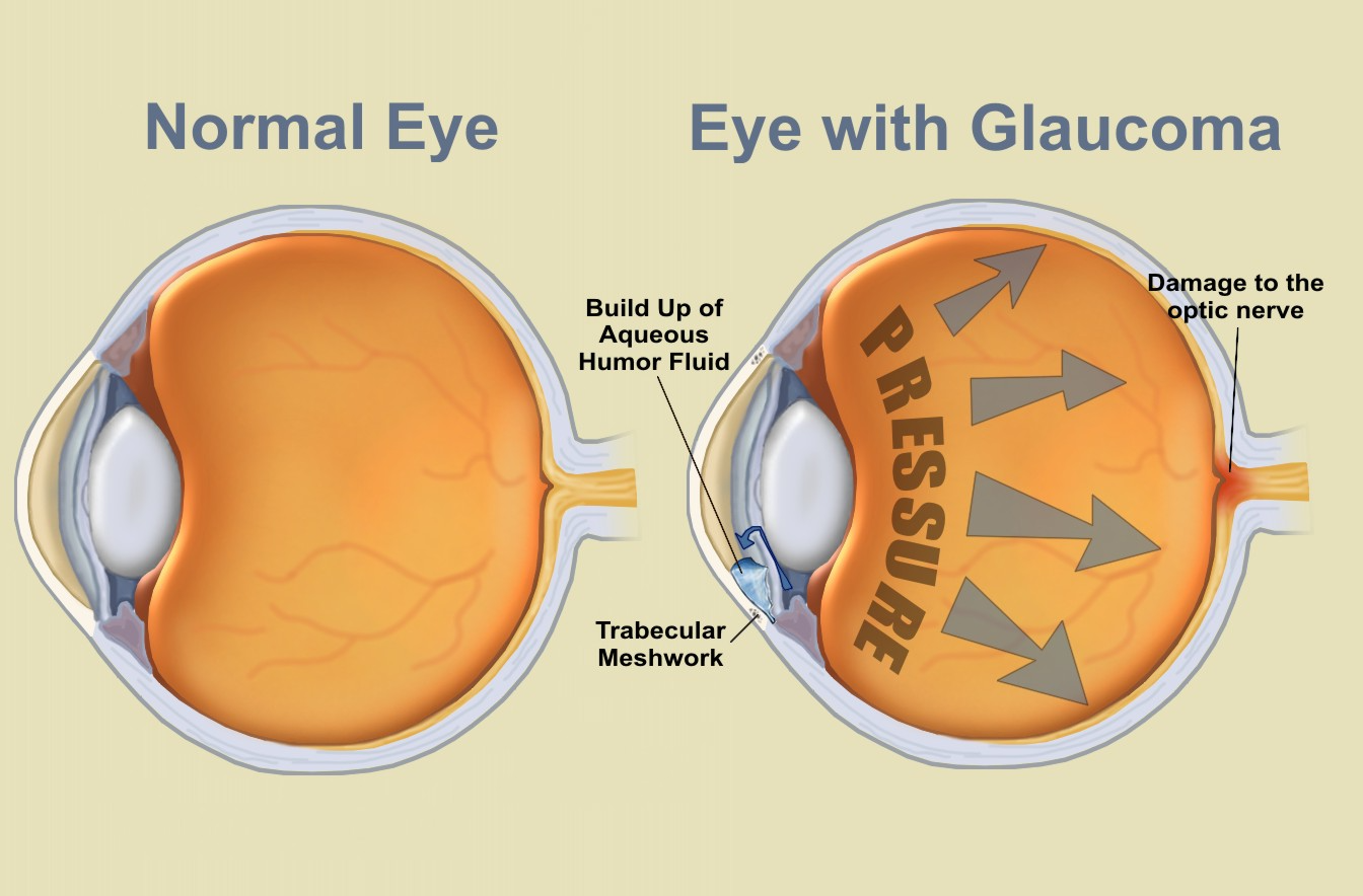 Superior segmental optic nerve hypoplasia: The topless disc syndrome -  ScienceDirect