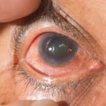 Close-up of an eye showing optic nerve health, used to illustrate early signs of glaucoma.